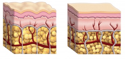 cellulite.jpg